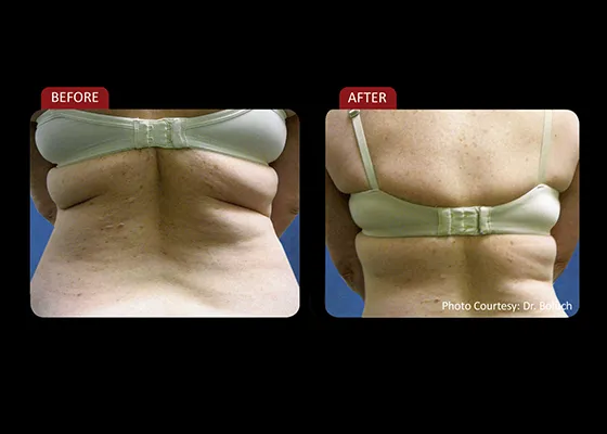 Chiropractic Reno NV Female Back Profile Before & After