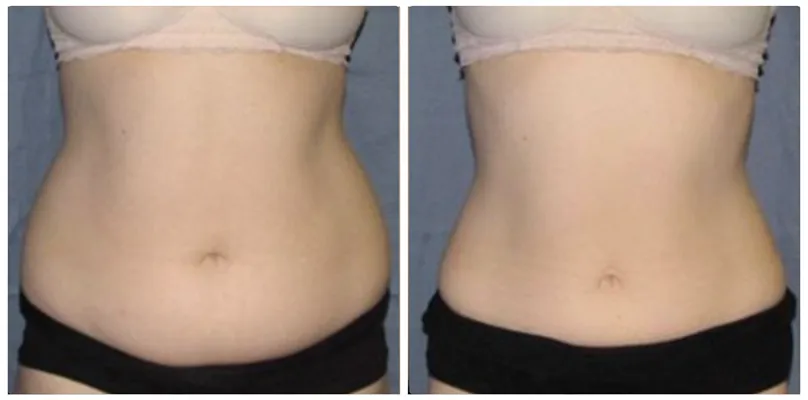 Chiropractic Reno NV Female Front Profile Before & After