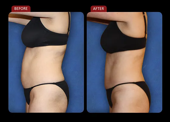 Chiropractic Reno NV Female Left Side Profile Before & After