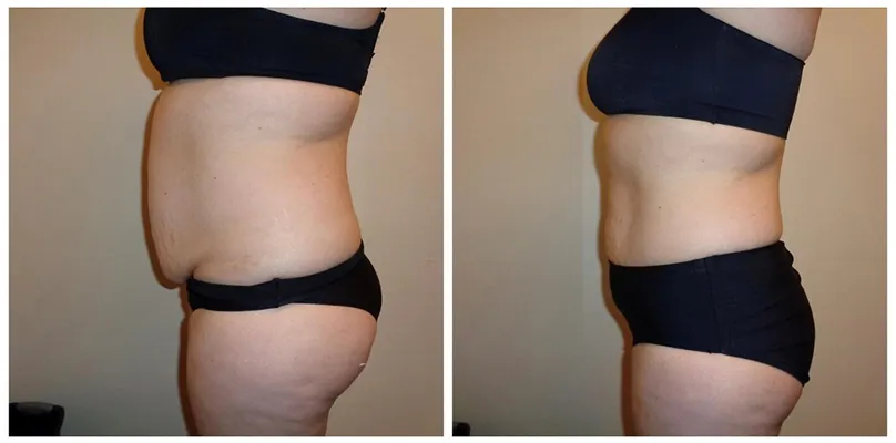 Chiropractic Reno NV Female Side Profile Before & After