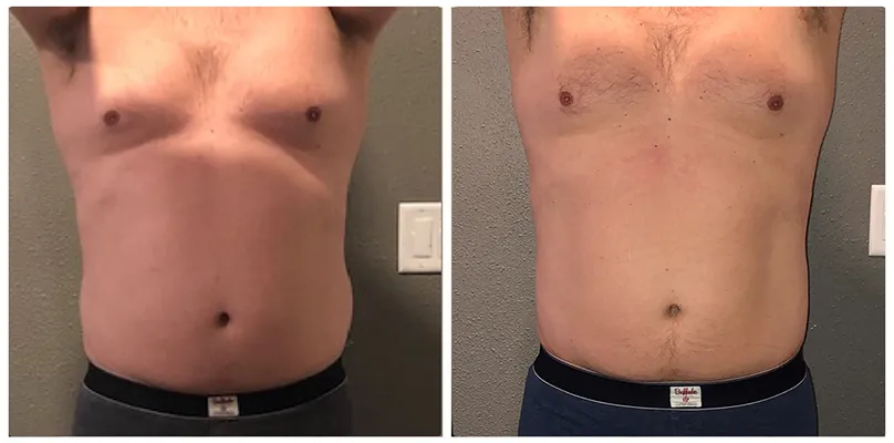 Chiropractic Reno NV Male Front Profile Before & After